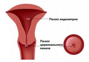 Полип цервикального канала при беременности