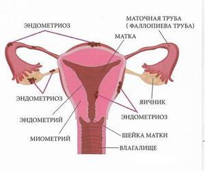 Что такое эндометриоз матки: симптомы и лечение у женщин, признаки, причины возникновения