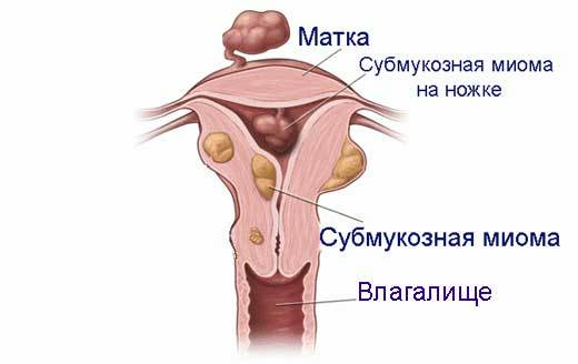 Миома матки малых размеров: причины, лечение, противопоказания, беременность