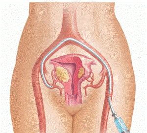 Удаление миомы матки (операция): последствия, отзывы, цена
