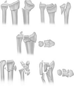 Переломы диафиза локтевой кости с вывихом го­ловки лучевой кости (типа Монтеджи)