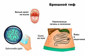 Брюшной тиф, паратифы А, В, С (typhus abdominalis)