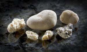 Как вывести камни из почек: 11 средств для лечения мочекаменной болезни