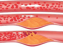 Атеросклероз коронарных артерий и вероятность инфаркта
