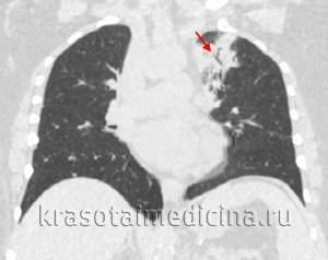 Пневмония (воспаления легких) - причины и характеристики
