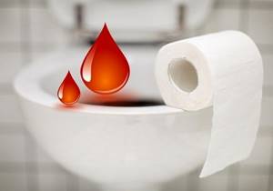 Кровь из заднего прохода: 9 причин анального кровотечения и как их лечить?