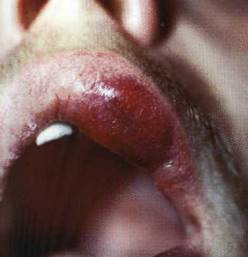 Антисептик для дезинфицирования язвочек, абсцессов и ран в полости рта