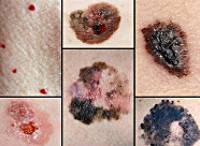 Какие виды опухолей кожи бывают?