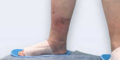 Осложнения варикозного расширения вен ног