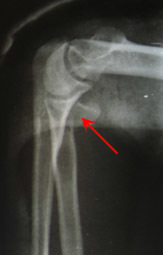 Переломы венечного отростка локтевой кости