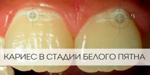 Народное средство использованное при зубной боли