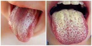 Кандидоз слизистых оболочек полости рта, языка