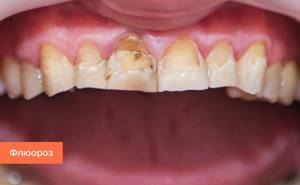 Инфекционные болезни зубов и десен: Какой риск они представляют?