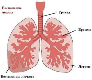 Пневмония - причины, симптомы и лечение