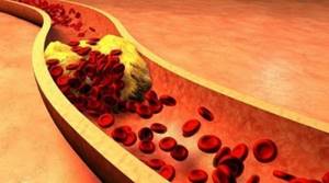 Как снизить холестерин в крови: методы, лекарства и народные средства