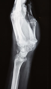 Изолированный перелом лучевой кости в типичном месте (на границе верхней и средней трети)