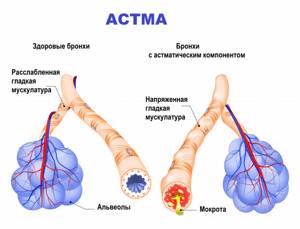 Бронхиальная астма - причины, симптомы и обострение