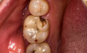 Кариес молочных зубов: причины, симптомы, лечение и профилактика