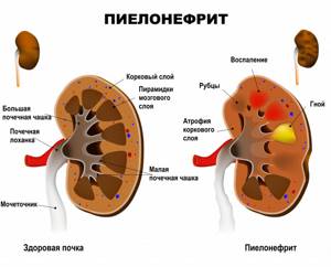 Подробно про пиелонефрит: причины, симптомы и лечение болезни