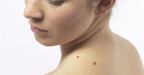 Какие виды опухолей кожи бывают?