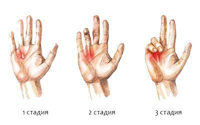 Операции по поводу заболевании пальцев кисти и стопы