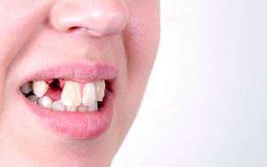 Средство для облегчения воспаления после удаления зуба