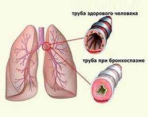 Аспириновая астма: причины, симптомы и механизм возникновения бронхоспазма