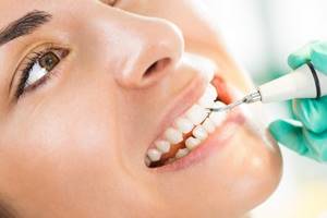 Зубной камень - симптомы и лечение