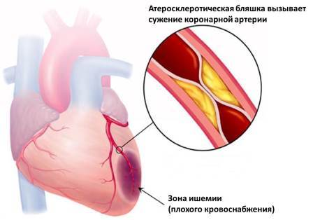 Методы и способы лечения болезней коронарных сосудов сердца