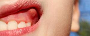 Лечение вскрытых абсцессов и незаживающих язв полости рта