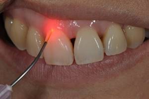 Зубной камень - симптомы и лечение