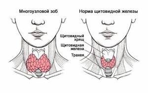 Правила при лечении заболеваний щитовидной железы