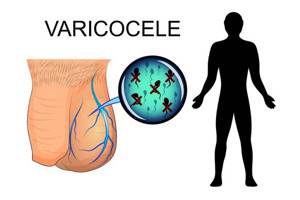 Варикоцеле - главная причина бесплодия у мужчин