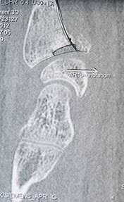 Изолированный перелом лучевой кости в типичном месте (на границе верхней и средней трети)