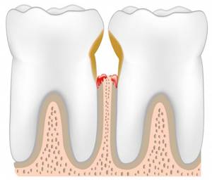 Успокаивающие компрессы при сильной зубной боли и отечности десен