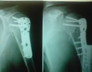 Переломы диафиза плечевой кости