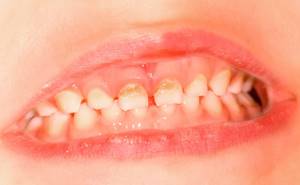 Кариес молочных зубов: причины, симптомы, лечение и профилактика
