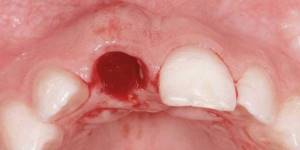 Кровотечение после хирургического удаления зуба