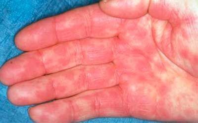 Аллергия на лекарства: Что такое токсидермия и как она проявляется?
