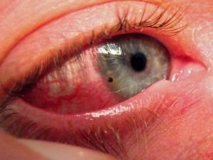 Проникающие ранения глазного яблока