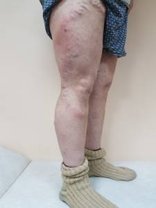 Осложнения варикозного расширения вен ног
