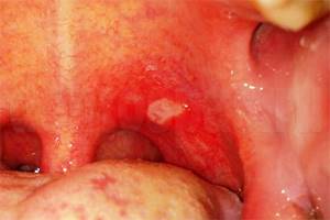 Лечение воспалительных болезней полости рта чаем с чесноком