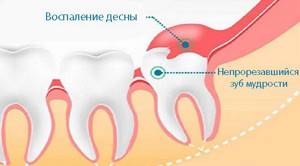 Перикоронарит (зуб мудрости) - симптомы и лечение