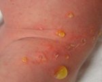 Детские кожные заболевания: Уход за кожей новорожденного