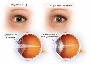 Что такое катаракта: симптомы, причины и лечение болезни