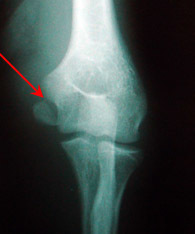 Переломы венечного отростка локтевой кости