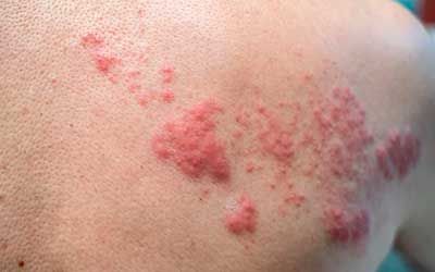 Бактериальные инфекции кожи