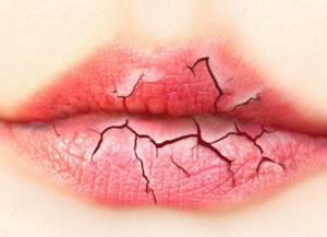 Потрескавшиеся губы? 11 средств, которые помогут, если они потрескались