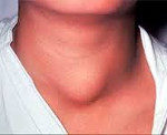 Рак щитовидной железы - причины, симптомы и лечение