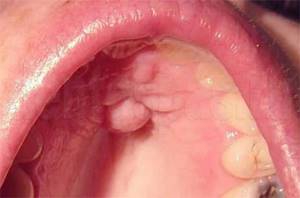 Лечение воспалительных болезней полости рта чаем с чесноком
